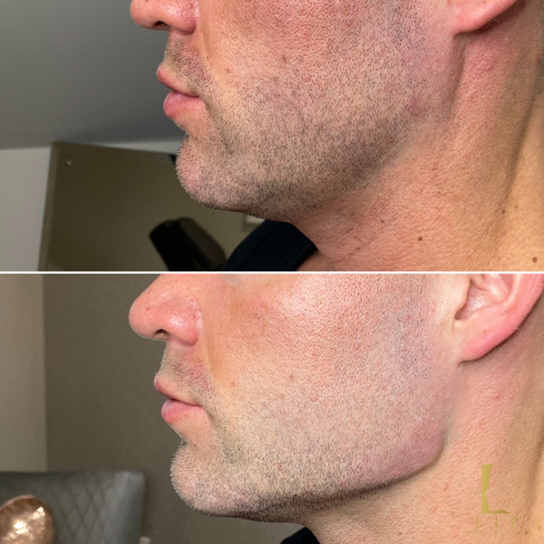 How Dermal Fillers Can Change The Jawline In Men Doctor Lanna