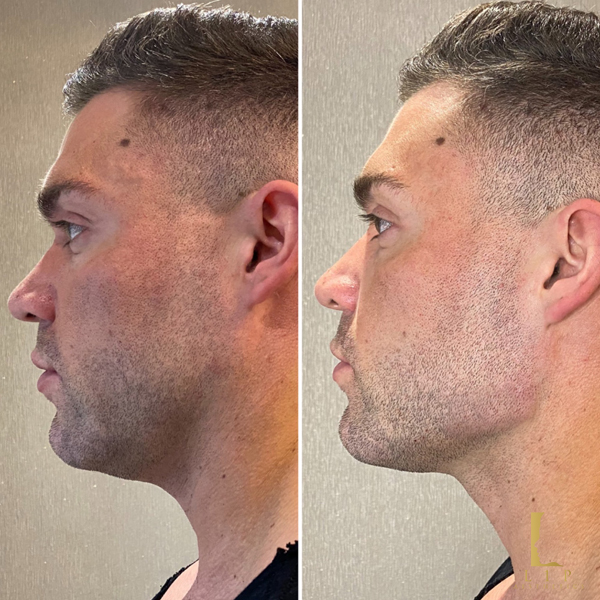 Beautiful Jaw Filler Transformations in Our Luxury Clinic