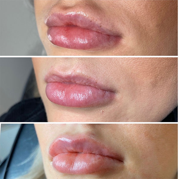 How to fix migrated lip filler