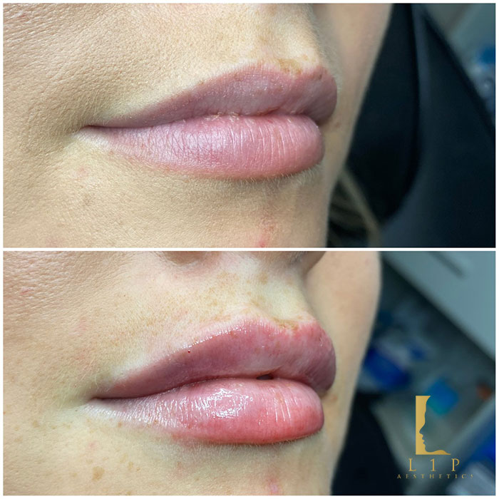 How to Get the Lips You Want: Natural Lip Enhancement