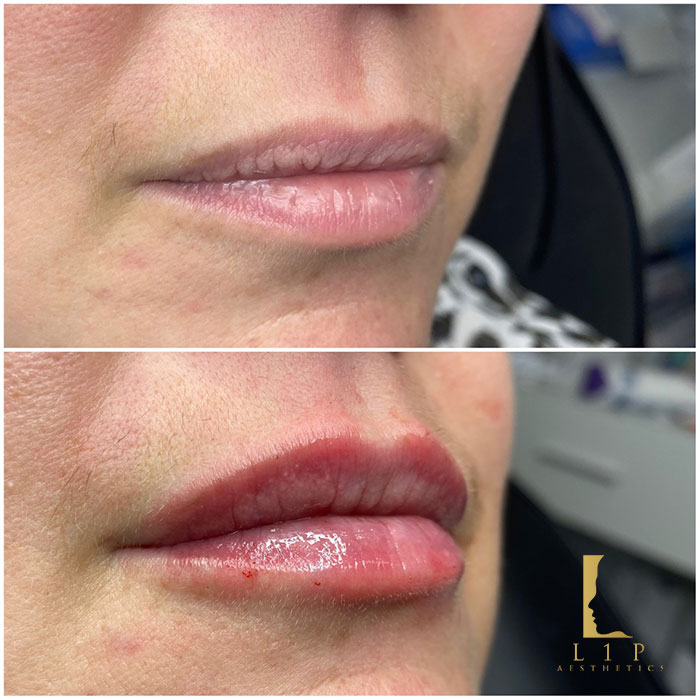 how-much-lip-filler-do-i-need-by-dr-ranjbar-l1p