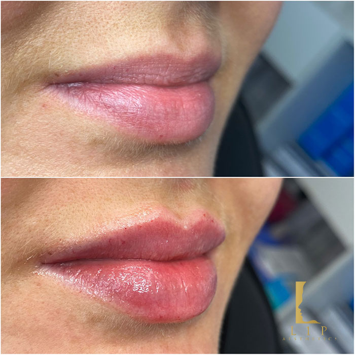 How Much Lip Filler Do I Need? By Dr Ranjbar - L1P