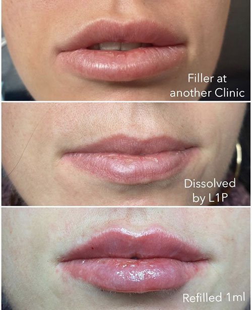 Lip Filler Aftercare - b clinic